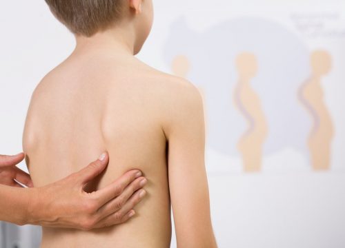 Child with scoliosis