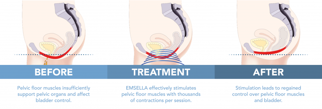 Before and after Emsella result information
